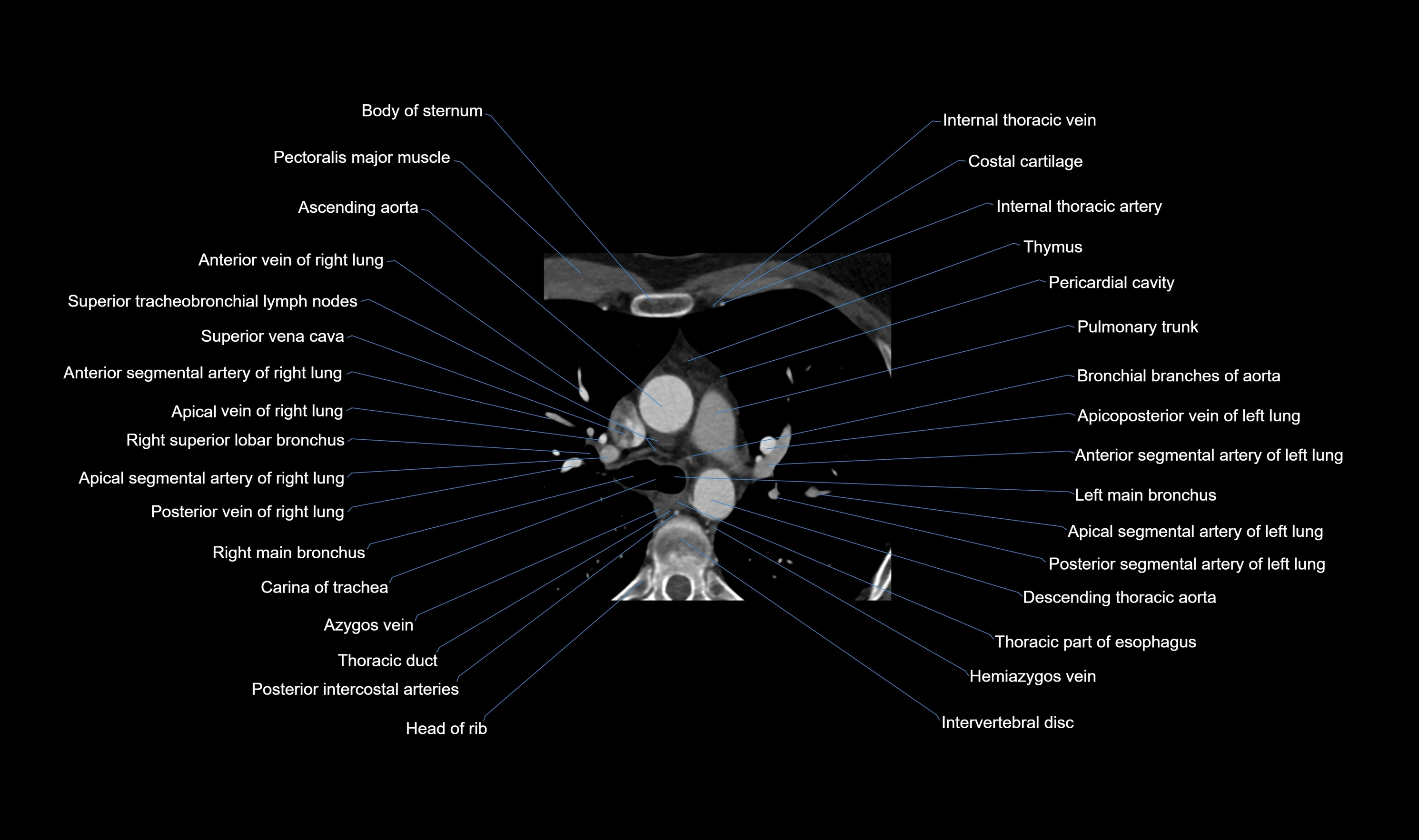 CT heart (coronary angiogram) axial view cross sectional anatomy labelled radiology image-00004.webp